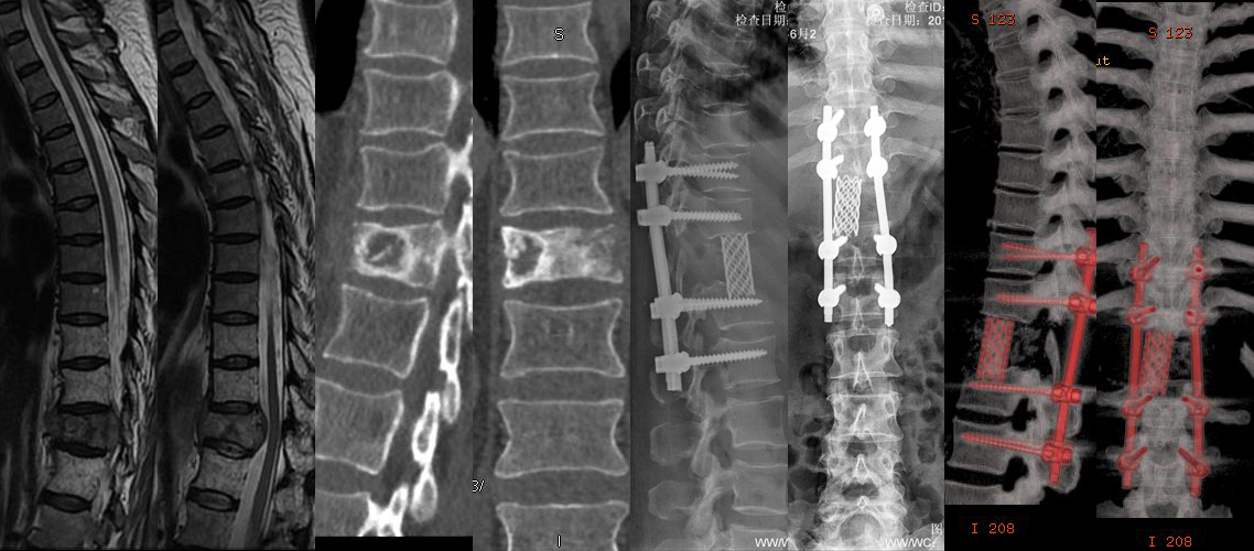 胸椎腫瘤切除植骨內固定術（女，52歲）.jpg