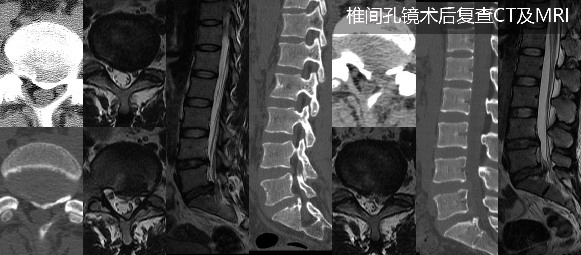 椎間孔鏡下合并鈣化髓核摘除術（男，30歲）.jpg