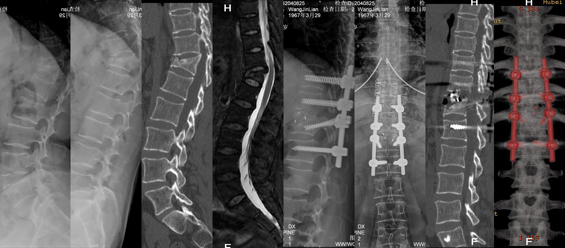 胸腰段后凸畸形矯形植骨內固定術（女，57歲）.jpg
