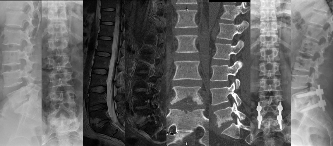 腰椎椎感染前后路病灶清除植骨固定術（男，38歲）.jpg