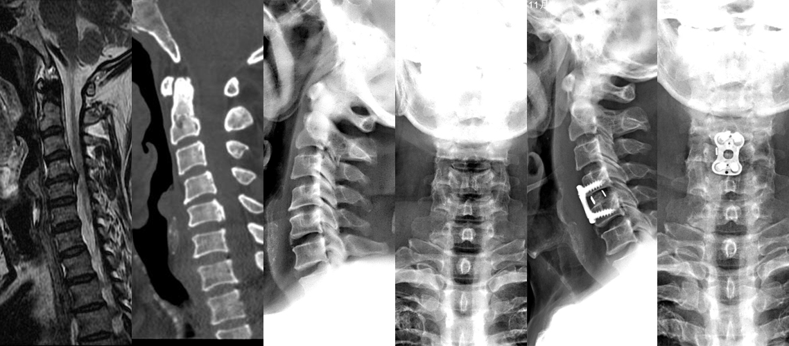頸椎前路椎間盤切除植骨內固定術ACDF（男，62歲）.jpg