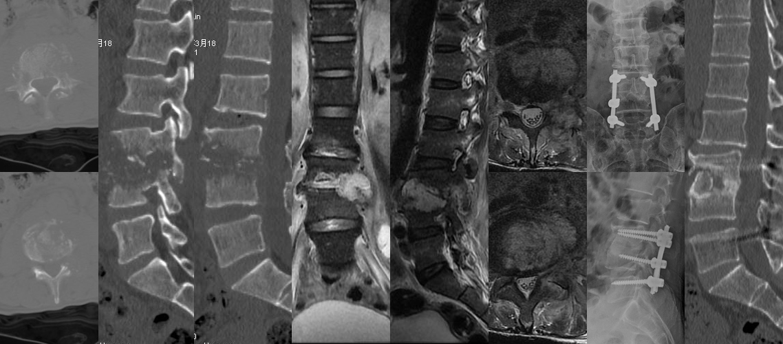 腰椎結核前后路病灶清除植骨固定術（男，55歲）.jpg