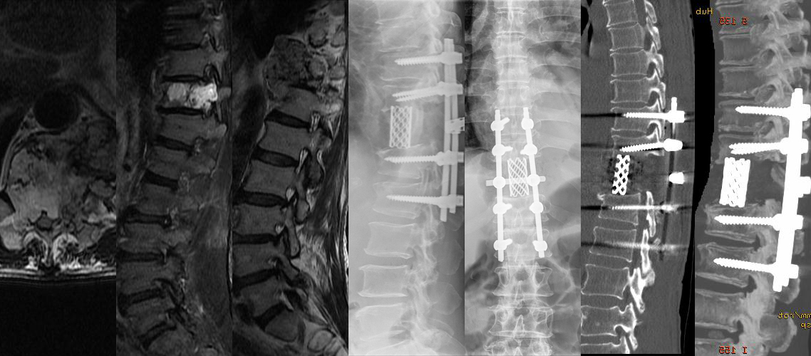 腰椎腫瘤切除植骨內固定術（男，59歲）.jpg