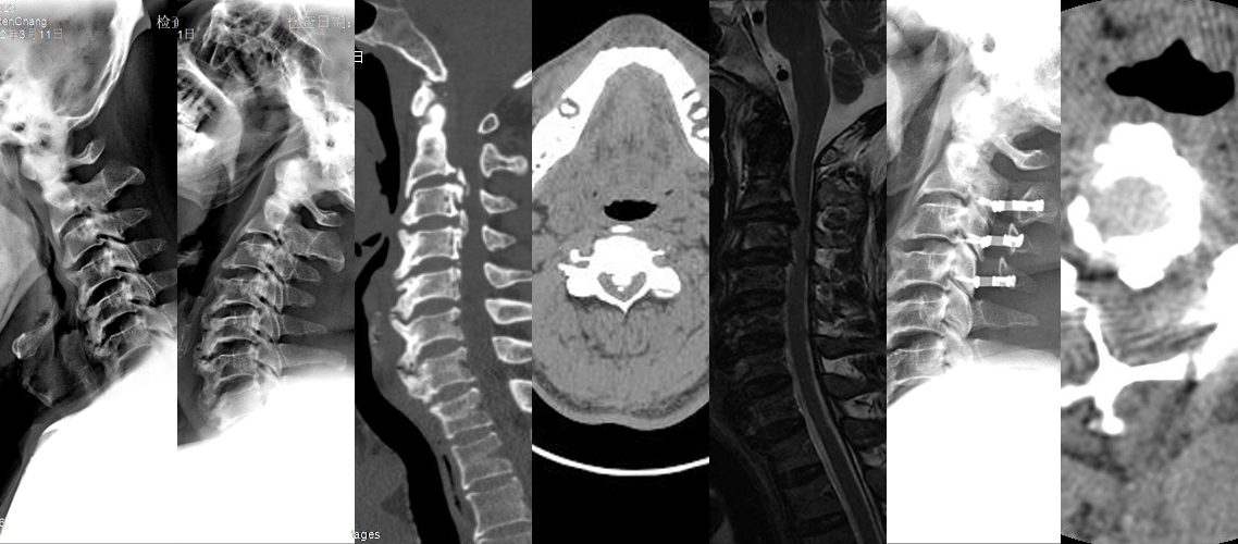 頸椎后路單開門微型鋼板固定術-后縱韌帶鈣化（男，56歲）.jpg