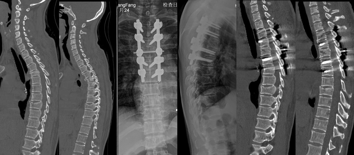 上胸椎骨折復位內固定術（女，45歲）.jpg