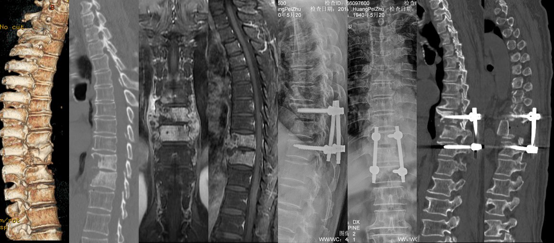 胸椎感染后路病灶清除植骨固定術（男，78歲）.jpg