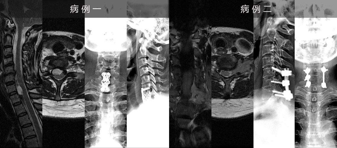 頸椎神經源性腫瘤切除固定術（病例一、女，43歲；病例二、女，54歲）.jpg