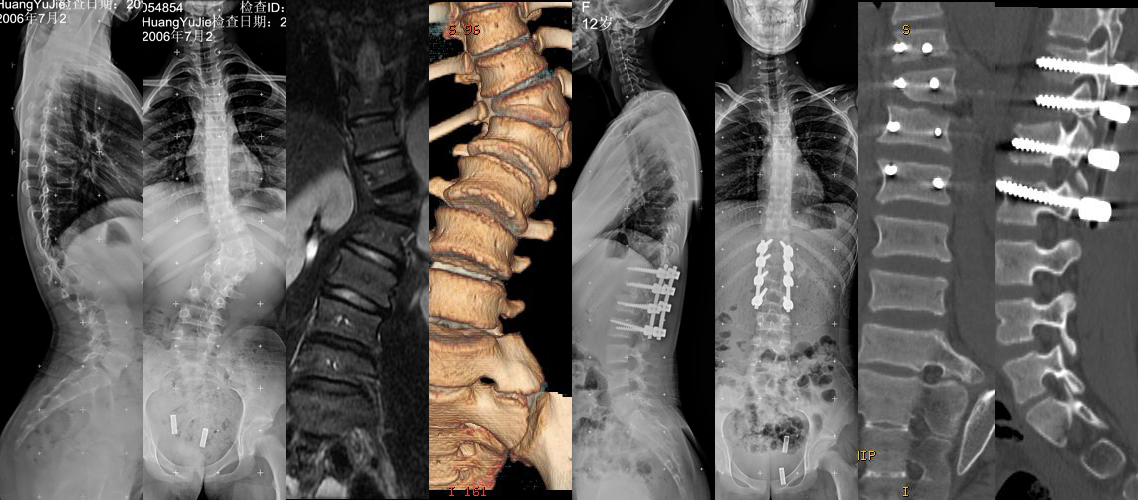 胸腰段半椎體畸形矯形植骨內固定術（女，12歲）.jpg