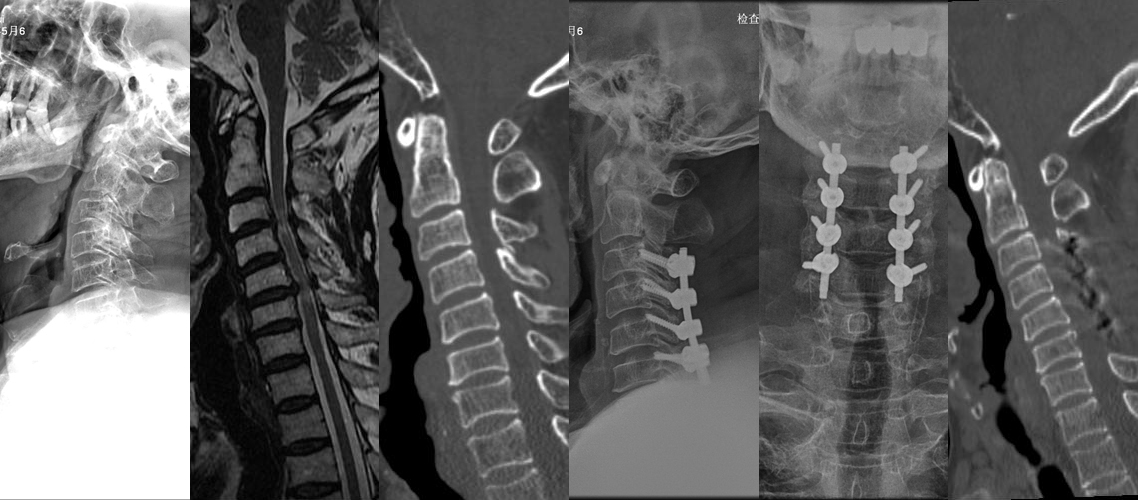 頸椎后路減壓側塊螺釘固定植骨融合術（男，74歲）.jpg
