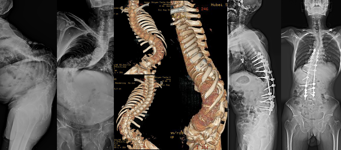 特發性脊柱側彎矯形內固定術（男，48歲）.jpg