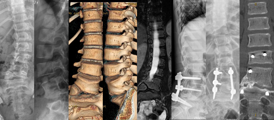 腰椎半椎體畸形矯形植骨內固定術（男，17歲）.jpg