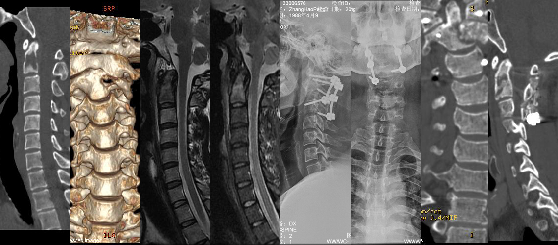 頸椎腫瘤切除植骨融合內固定術（男，30歲）.jpg